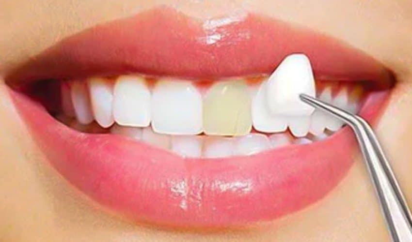 10 Effective Ways On How To Maintain Your Veneers - Salt Lake Dental
