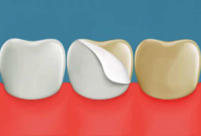 Veneers