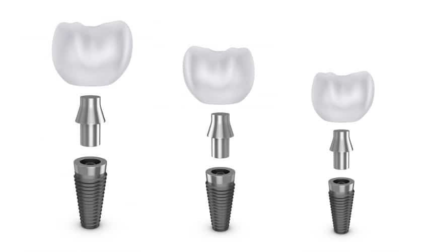 Dental Implants 7 Facts You Should Know