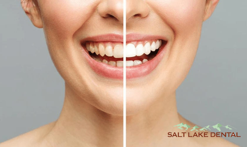 teeth whitening cost