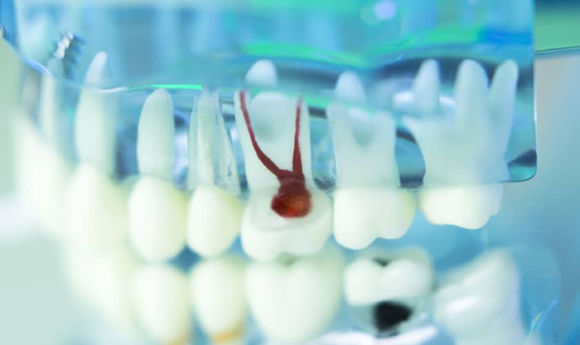Root Canal Treatment