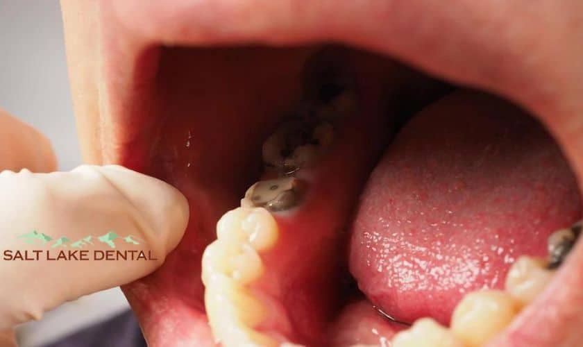 What You Need To Know About Tooth Decay