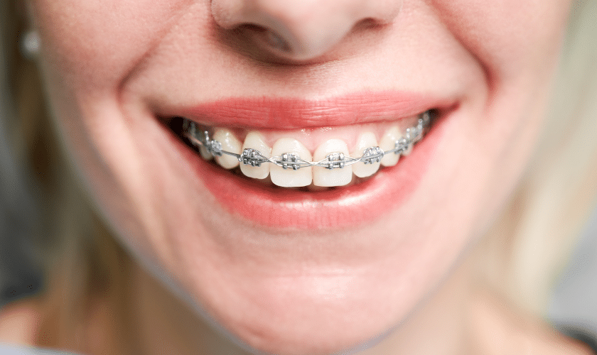 six-month smile braces