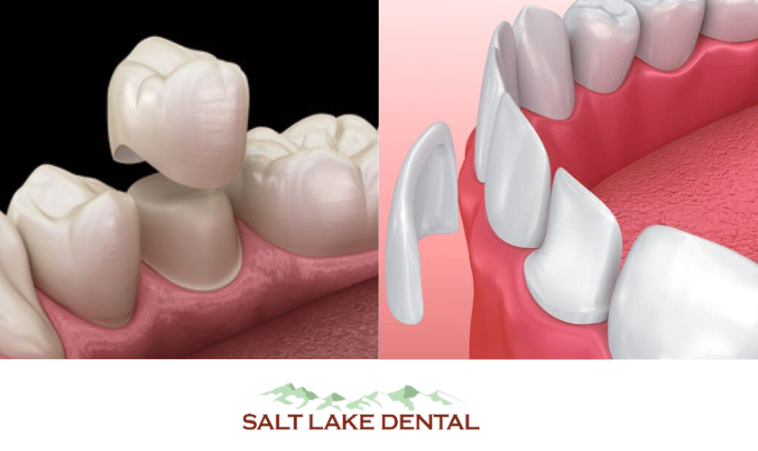What Are The Differences Between Veneers And Crowns?