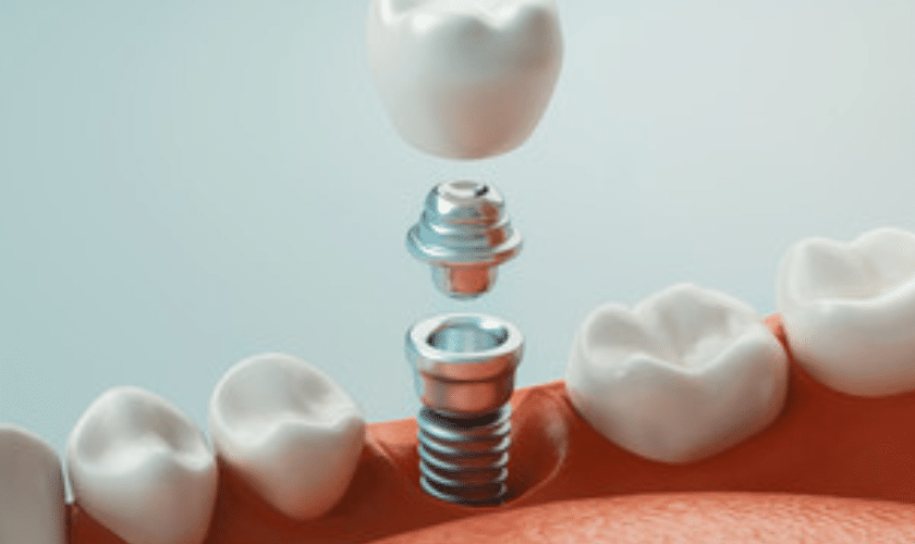The Benefits Of Mini Dental Implants