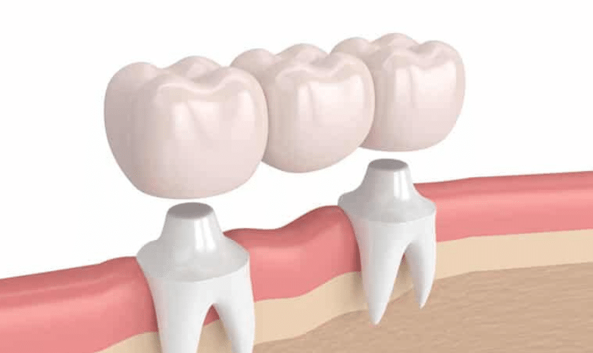 The Right Candidate For Dental Bridges