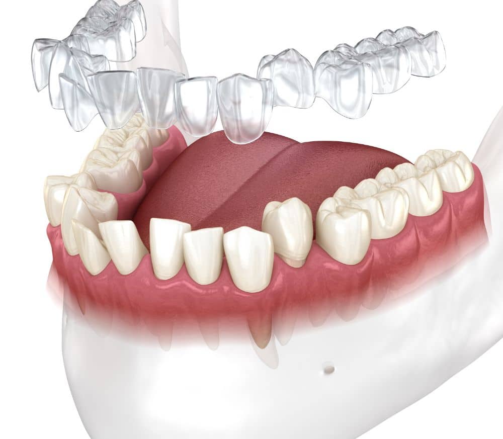 Invisalign Dentist in Salt Lake City at Salt Lake Dental