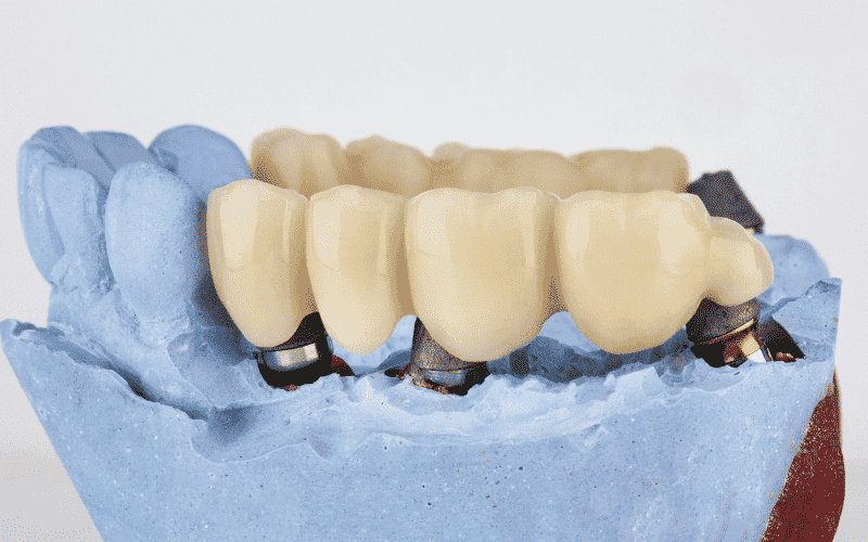 Dental Bridges