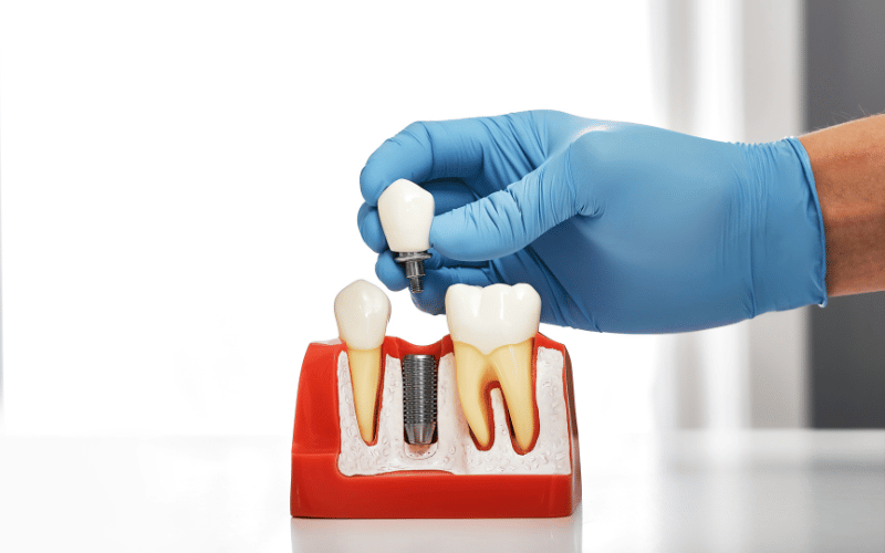 how-to-prepare-dental-implant-surgery