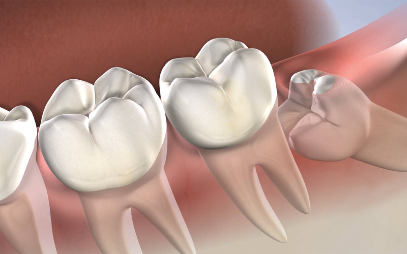 Why Timely Wisdom Tooth Extraction Matters
