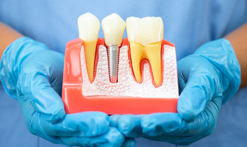 dental implants in Salt Lake City