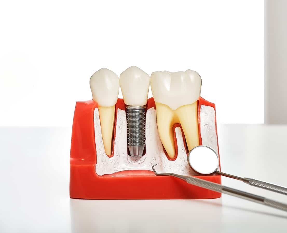Dental Implants in Willard